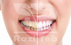 تغییر رنگ دندان اولین نشانه دندان درد