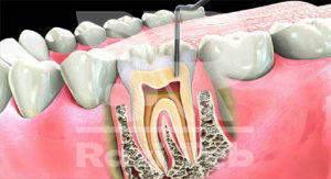فهرستی از علل دندان درد و مراحل پیدایش آن