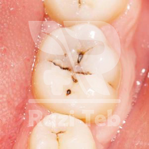 مراحل اولیه پوسیدگی دندان